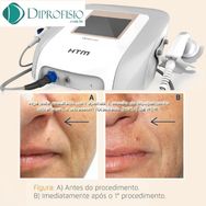 Ultrafocus Htm – Aparelho de Lifting Facial