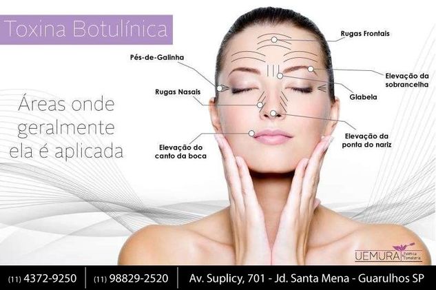 Aplicação de Botox em Guarulhos