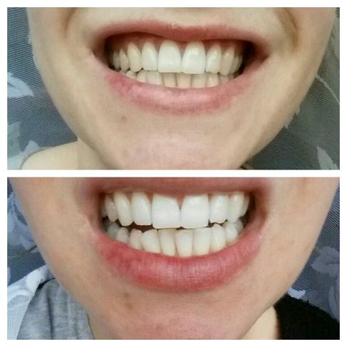 Kit de Clareamento Dentário / Dental / Dente 44% de Peróxido com 10