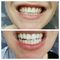 Kit de Clareamento Dentário / Dental / Dente 44% de Peróxido com 10
